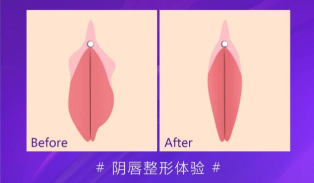 小陰唇切除手術(shù)成都