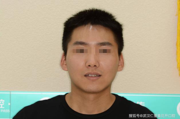 小哥哥歷經(jīng)2年矯正之旅-顏值攀升。
