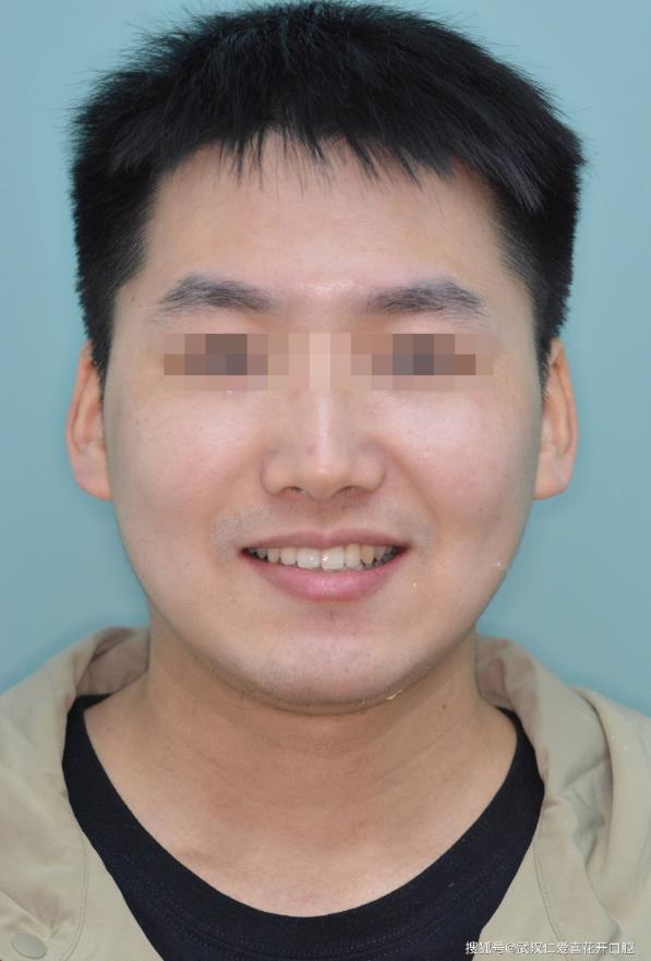 小哥哥歷經(jīng)2年矯正之旅-顏值攀升!