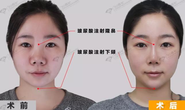 沈陽杏林整形外科醫(yī)院:國產(chǎn)玻尿酸和進(jìn)口玻尿酸哪個好?