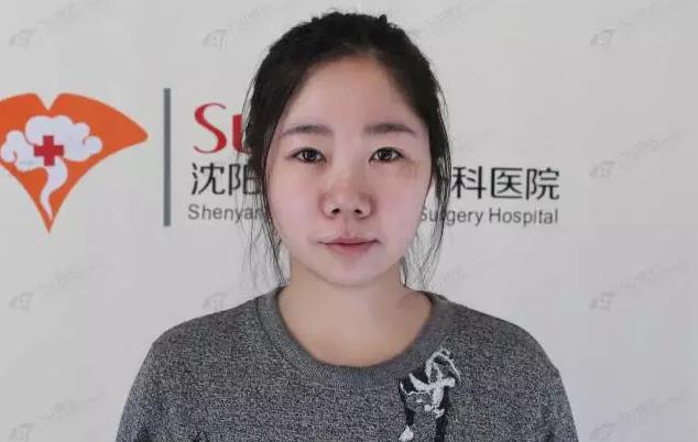 沈陽杏林整形外科醫(yī)院:國產(chǎn)玻尿酸和進(jìn)口玻尿酸哪個好?