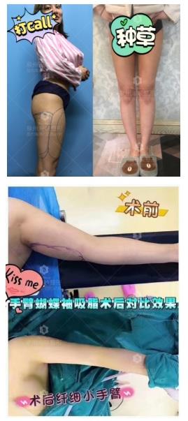 泉州海峽王振榮 年度最具影響力名醫(yī)大咖榜自體脂肪名醫(yī)