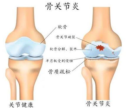 重慶哪個(gè)骨科醫(yī)院好-重慶看關(guān)節(jié)炎哪里好?重慶紅樓醫(yī)院