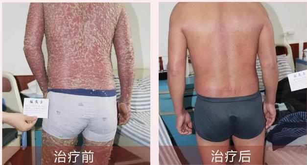 許光生:銀屑病會(huì)危及生命嗎?