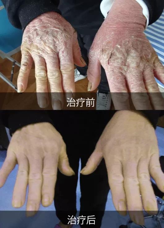 許光生:銀屑病會(huì)危及生命嗎?