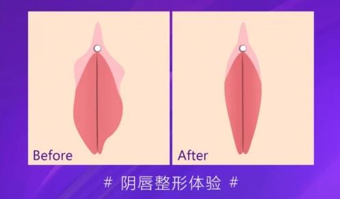 成都陰唇切除的醫(yī)院