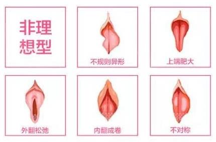 成都陰唇切除的醫(yī)院