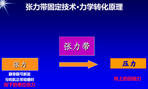 聯(lián)合麗格何照華教授:顴骨顴弓術(shù)后只能用鈦板鈦釘固定嗎? 1H33TD7-5.png