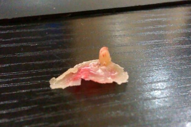 雞眼的癥狀圖片長什么樣子位置 雞眼挖出來的根部肉刺圖片