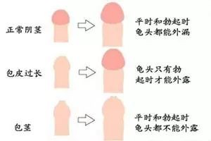 治療小兒包莖,從不忽悠!越來(lái)越多的學(xué)者選擇氣囊擴(kuò)張術(shù)