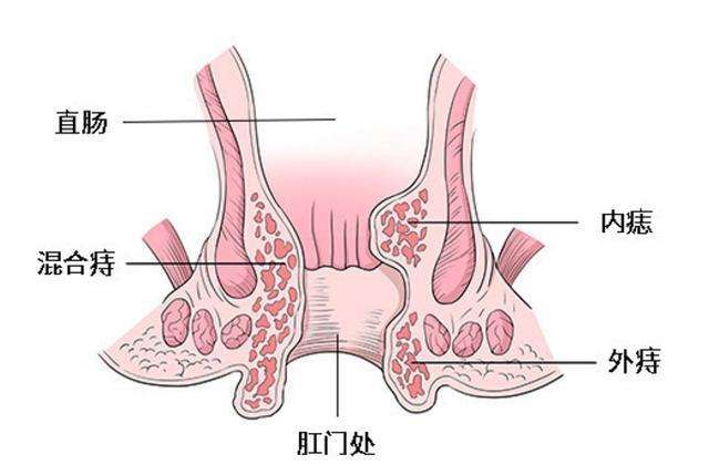 痔瘡長(zhǎng)什么樣子在哪個(gè)位置圖片 內(nèi)痔外痔混合痔肉球脫出癥狀對(duì)照?qǐng)D片