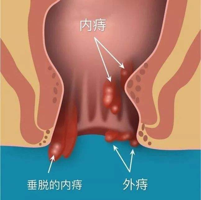 痔瘡長(zhǎng)什么樣子在哪個(gè)位置圖片 內(nèi)痔外痔混合痔肉球脫出癥狀對(duì)照?qǐng)D片