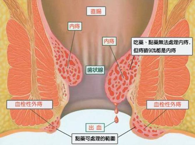 痔瘡長(zhǎng)什么樣子在哪個(gè)位置圖片 內(nèi)痔外痔混合痔肉球脫出癥狀對(duì)照?qǐng)D片