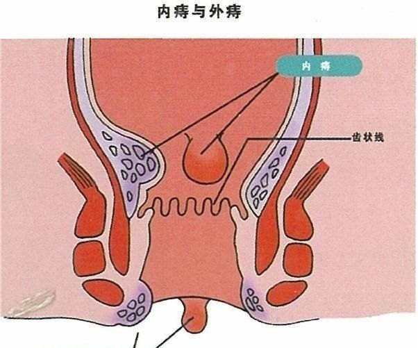 痔瘡長(zhǎng)什么樣子在哪個(gè)位置圖片 內(nèi)痔外痔混合痔肉球脫出癥狀對(duì)照?qǐng)D片