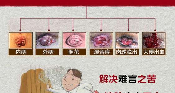 痔瘡長(zhǎng)什么樣子在哪個(gè)位置圖片 內(nèi)痔外痔混合痔肉球脫出癥狀對(duì)照?qǐng)D片