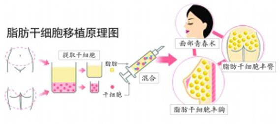 怎么填充太陽(yáng)穴才能避免臉變大,有太陽(yáng)穴凹陷的人來(lái)看看【劉靖濤填充醫(yī)生】