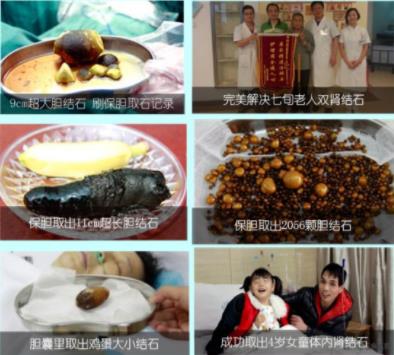 四川結(jié)石病醫(yī)院口碑 實力鑄就口碑:33%的患者慕名就醫(yī)