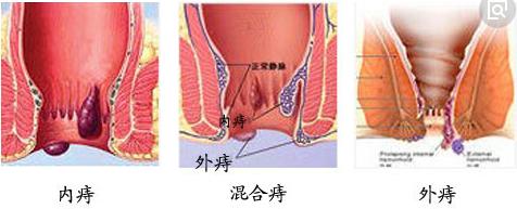 武漢馬應(yīng)龍肛腸醫(yī)院:怎樣對(duì)內(nèi)痔進(jìn)行鑒別
