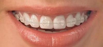 合肥補(bǔ)牙哪里好 合肥美奧口腔靠譜 效果看得見