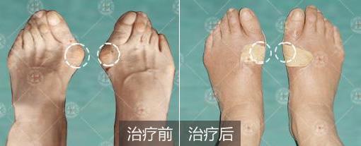 上海健橋醫(yī)院治療拇外翻(大腳骨)怎么樣?百姓點(diǎn)評(píng)排行