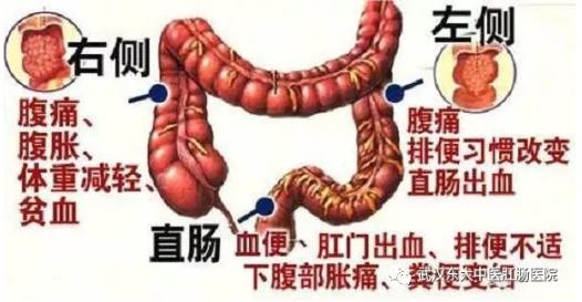 武漢東大肛腸醫(yī)院:記得重視腸道檢查