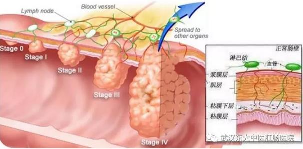 武漢東大肛腸醫(yī)院:記得重視腸道檢查