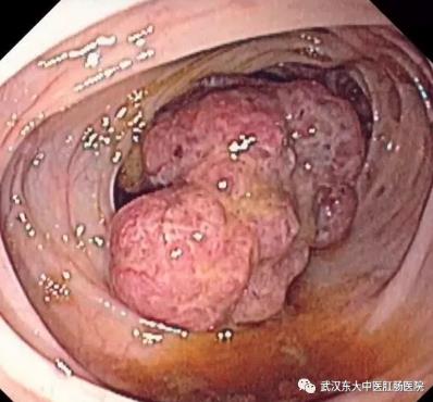 武漢東大肛腸醫(yī)院:記得重視腸道檢查