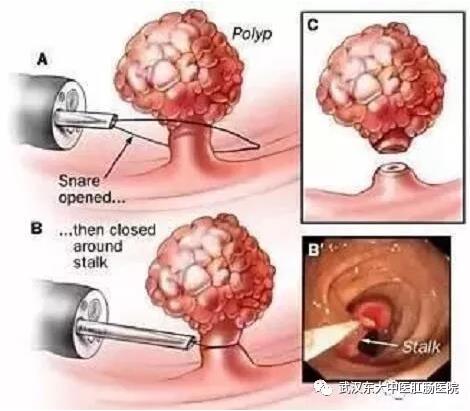 武漢東大肛腸醫(yī)院:記得重視腸道檢查