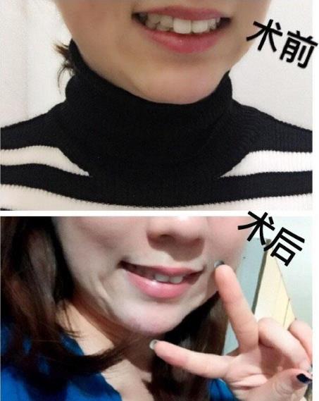 湛江矯正兔牙哪里好 致美口腔讓你靚麗人生從此啟程