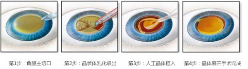 宜昌華廈眼科白內(nèi)障專家提醒:白內(nèi)障千萬不要“熟了”再做!