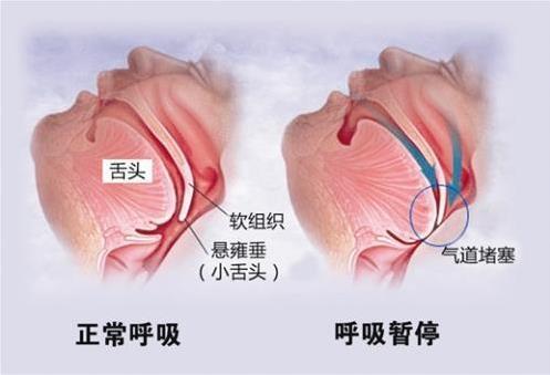 孩子腺樣體肥大,你反省了嗎?