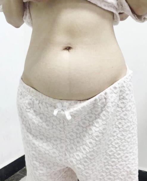 “拆彈”籃球大腫瘤,出血量僅2毫升,北京愛康醫(yī)療集團j精準(zhǔn)治療獲患者點贊
