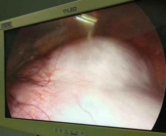 “拆彈”籃球大腫瘤,出血量僅2毫升,北京愛康醫(yī)療集團j精準(zhǔn)治療獲患者點贊