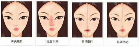 煤醫(yī)整形王英勇主任:人這一生能承受幾次鼻修復