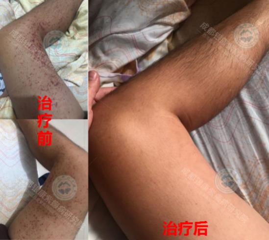 成都紫癜醫(yī)院哪家技術好?成都銀康3D超敏免疫生物療法體系好