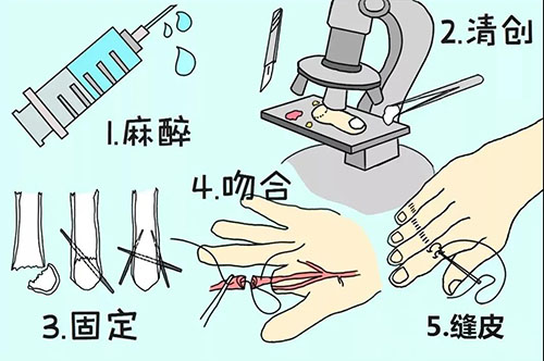 手指斷了怎么辦?濟南顯微外科醫(yī)院讓斷指失而復得! 11-12-1-500.jpg
