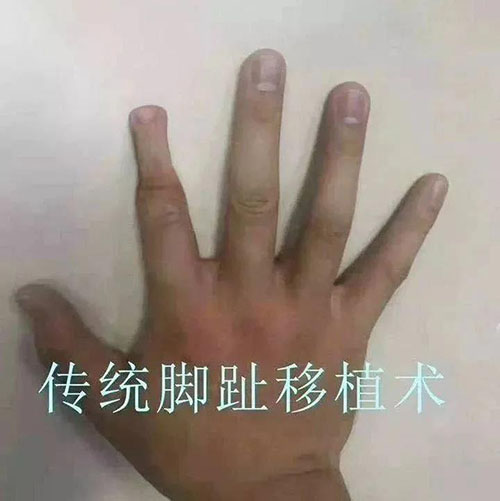 手指斷了怎么辦?濟南顯微外科醫(yī)院讓斷指失而復得! 11-3-3-500.jpg