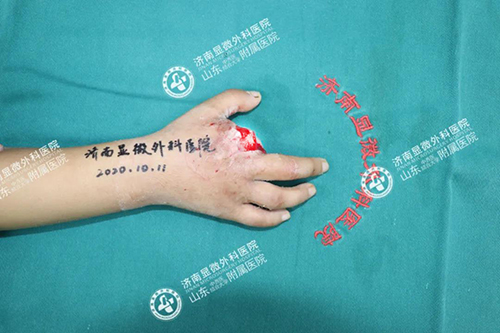 濟南顯微外科醫(yī)院 黃威成功為5歲女孩完成全形手指再造 10-22-1-500.jpg