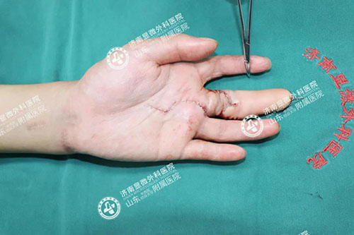 操作不慎導(dǎo)致手指缺失,3D全形手指再造技術(shù)讓斷指“重生” 11-2-3-500.jpg