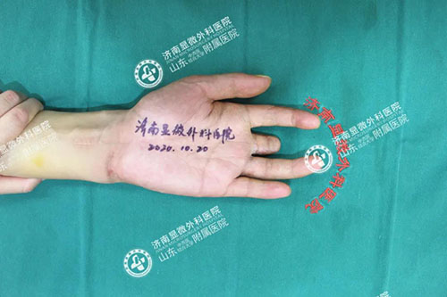 操作不慎導(dǎo)致手指缺失,3D全形手指再造技術(shù)讓斷指“重生” 11-2-1-500.jpg