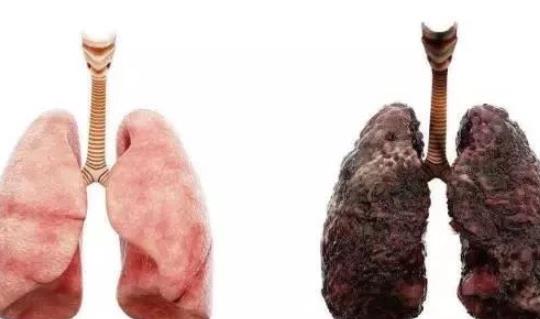 死亡率最高的病 肺癌發(fā)病率和死亡率最高