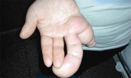 世界上最大的手 巨指病人劉華左手拇指測(cè)量長(zhǎng)達(dá)26厘米