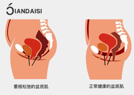產(chǎn)后縮陰用什么產(chǎn)品比較好?安全很重要!