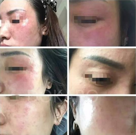 還在煩惱痘痘怎么治?看這里,植晰教你科學(xué)祛痘