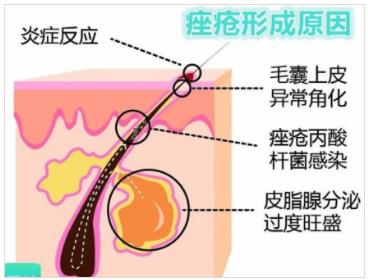 北京伊美爾幸福醫(yī)院:閉口粉刺會自己慢慢消失嗎?