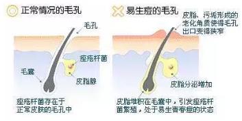 田永成醫(yī)美教你如何有效祛痘