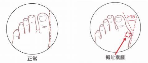 干預(yù)孩子足部拇外翻問題,可科學(xué)定制矯正鞋墊