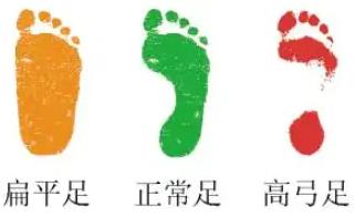 關(guān)心孩子的腳,及早穿著矯正鞋干預(yù)扁平足