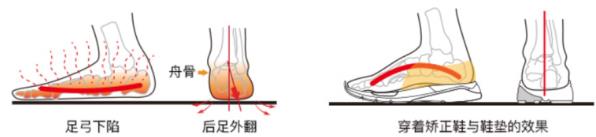干預(yù)嚴重扁平足,科學(xué)穿著矯正鞋進行
