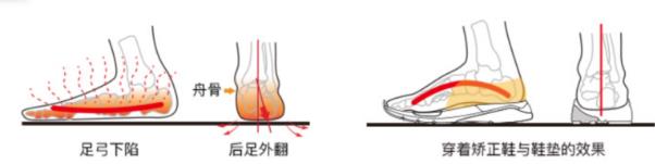 足外翻要重視,穿矯正鞋進(jìn)行科學(xué)干預(yù)
